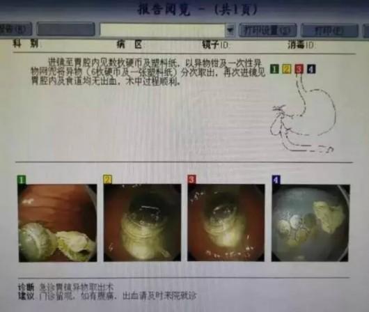 吞到胃里的硬币