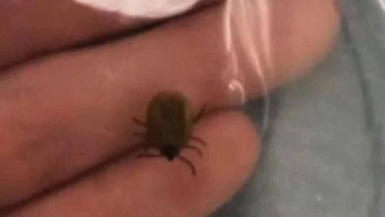 女童被蜱虫叮咬导致神经中毒引起肢体瘫痪