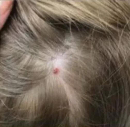 女童被蜱虫叮咬导致神经中毒引起肢体瘫痪