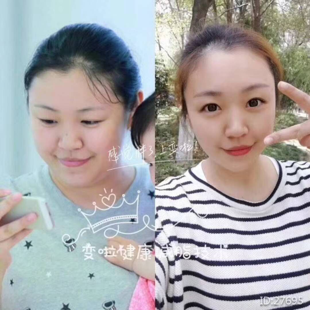 科学去脂减肥效果案例 健康减脂技术 肥胖的治疗 科学减肥方法