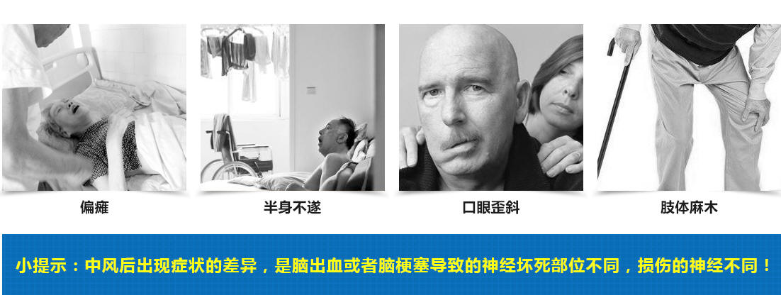 中风 脑出血 脑梗塞 偏瘫 半身不遂 扣眼歪斜 肢体麻木