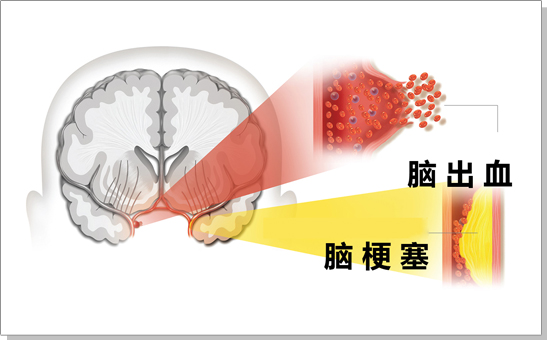 中风 脑出血 脑梗塞治疗新方法