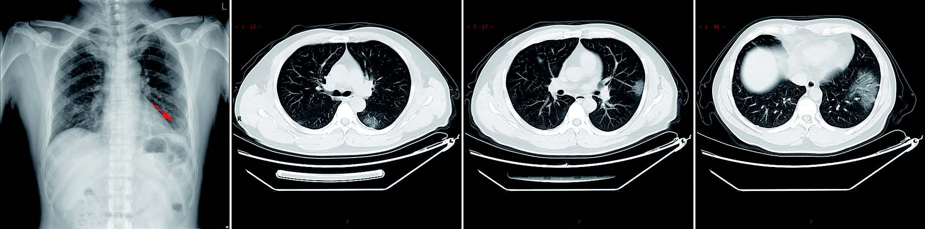 新型冠状病毒性肺炎典型CT/X线影像表现