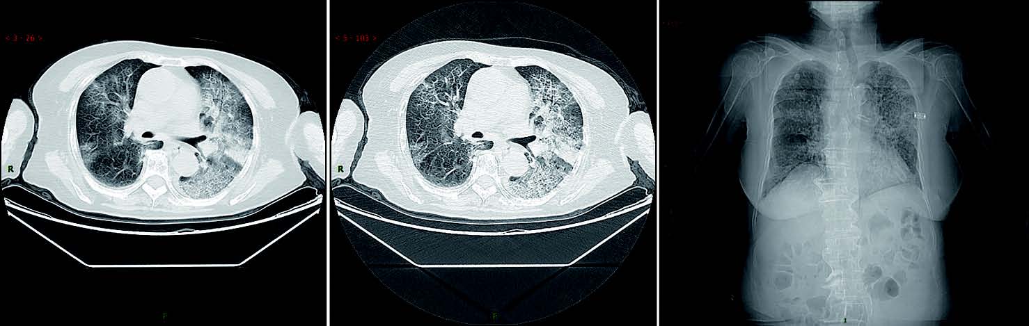 新型冠状病毒性肺炎典型CT/X线影像表现