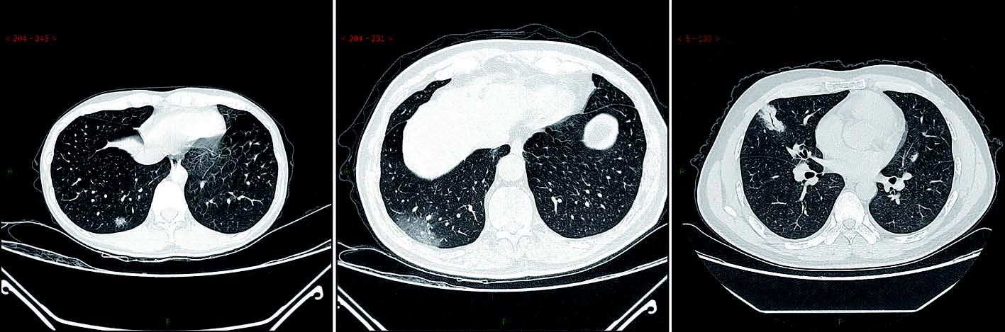 新型冠状病毒性肺炎典型CT/X线影像表现
