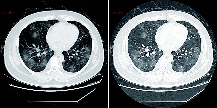 新型冠状病毒性肺炎典型CT/X线影像表现