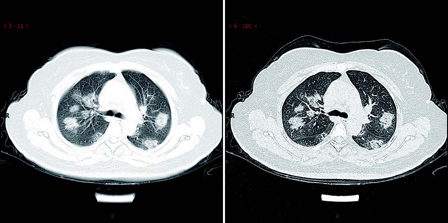 新型冠状病毒性肺炎典型CT/X线影像表现
