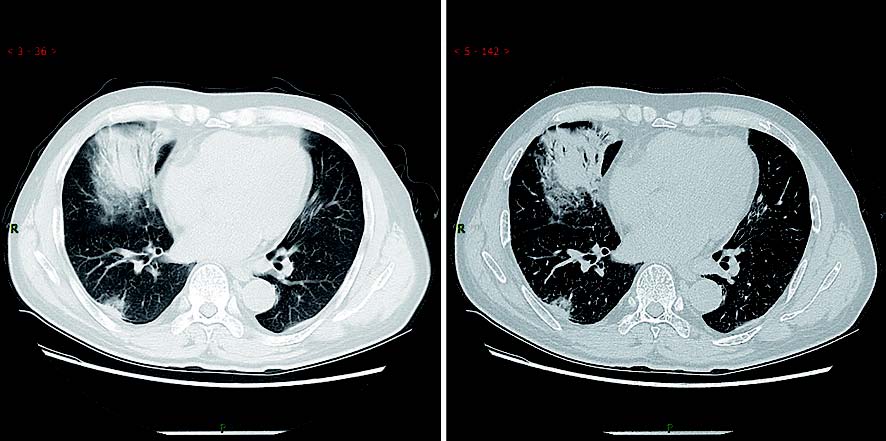 新型冠状病毒性肺炎典型CT/X线影像表现