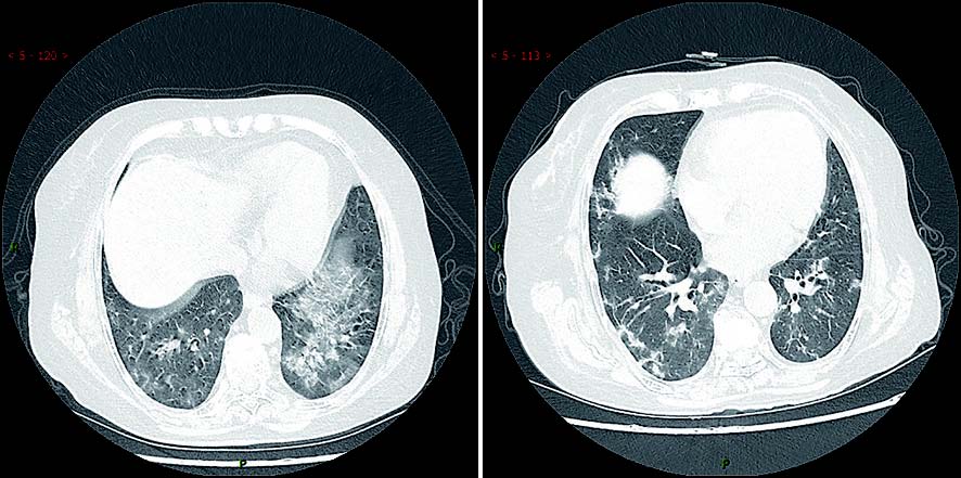 新型冠状病毒性肺炎典型CT/X线影像表现